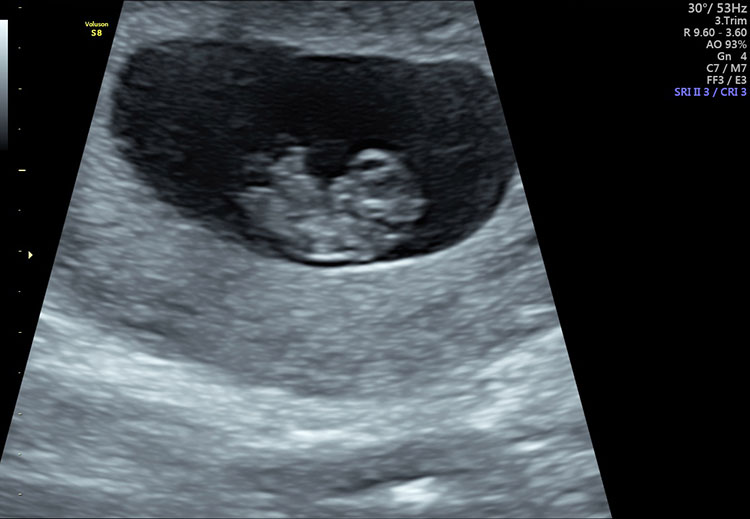 How soon can a dating ultrasound be done