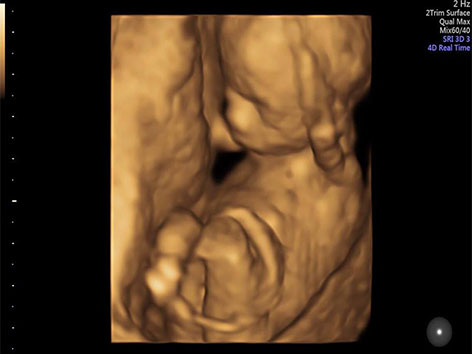 3d 4d Ultrasound Scans How Do They Work Window To The