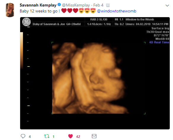 Savannah Kemplay From MTV Says Hello to Baby 4D Gender Scan