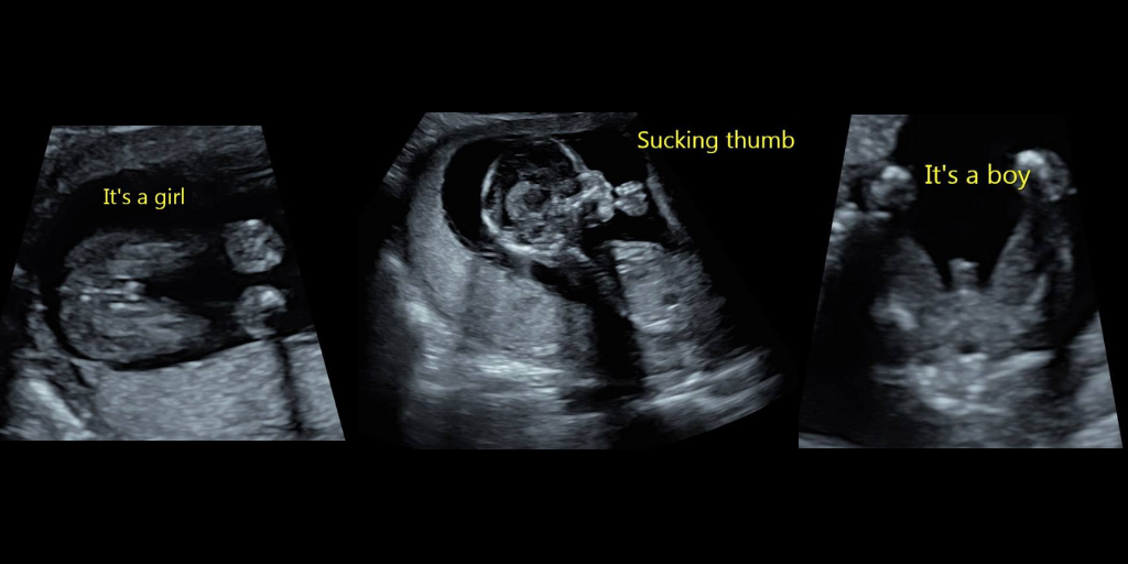 Gender reveal scan Baby Scans