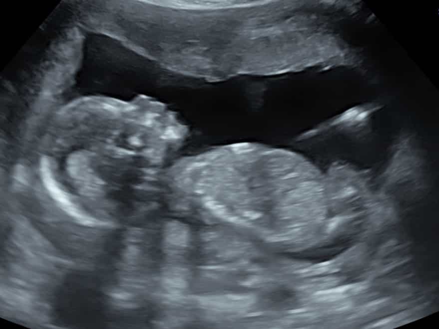 Fetal Growth Ultrasound 