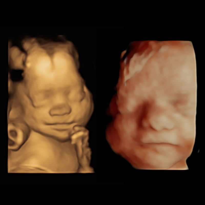 Our 3d4d Scan Explained Window To The Womb