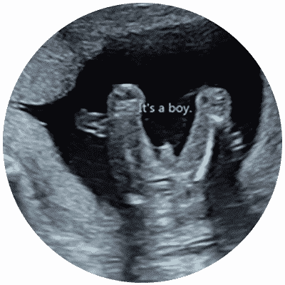 Confirmation scan gender Ultrasound gender