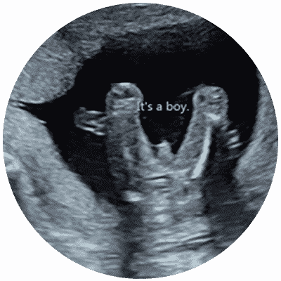 Early Gender Ultrasound Scan Chessington Surrey