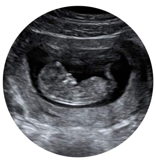 Pregnancy scan at 4 weeks