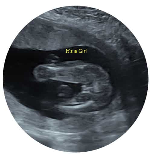 Private Gender Ultrasound Scan Middlesbrough