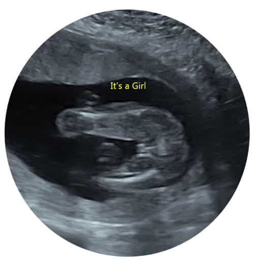 Private Gender Ultrasound Baby Scan, Bagshot Surrey