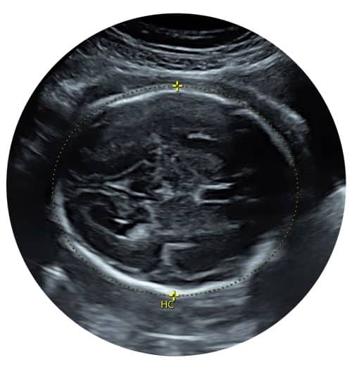 Private Growth Ultrasound Scan, Rayleigh, Essex