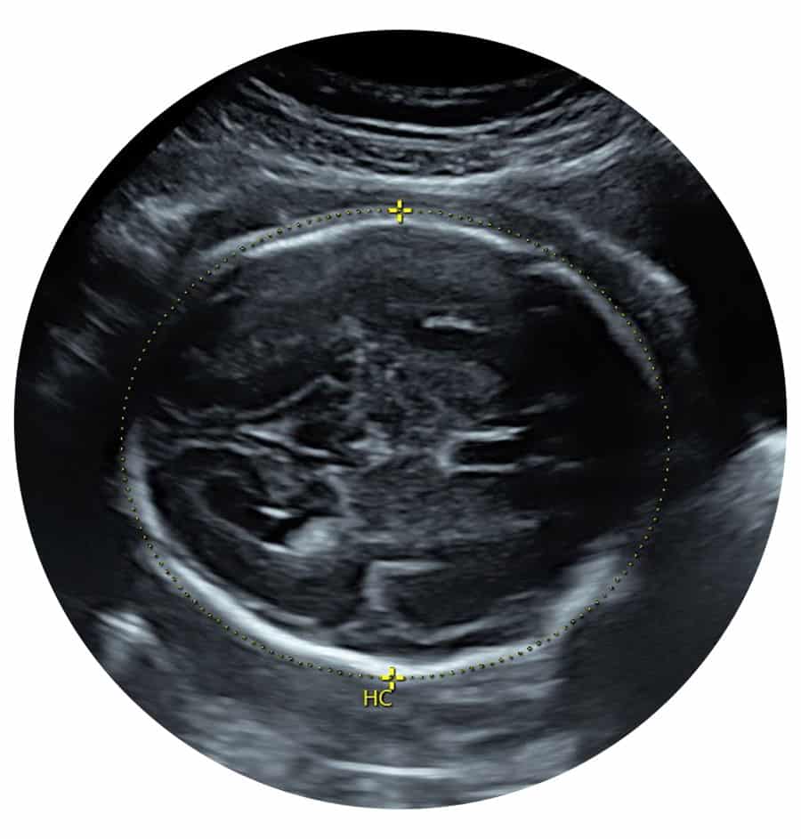 Private Growth Ultrasound Scan Middlesbrough