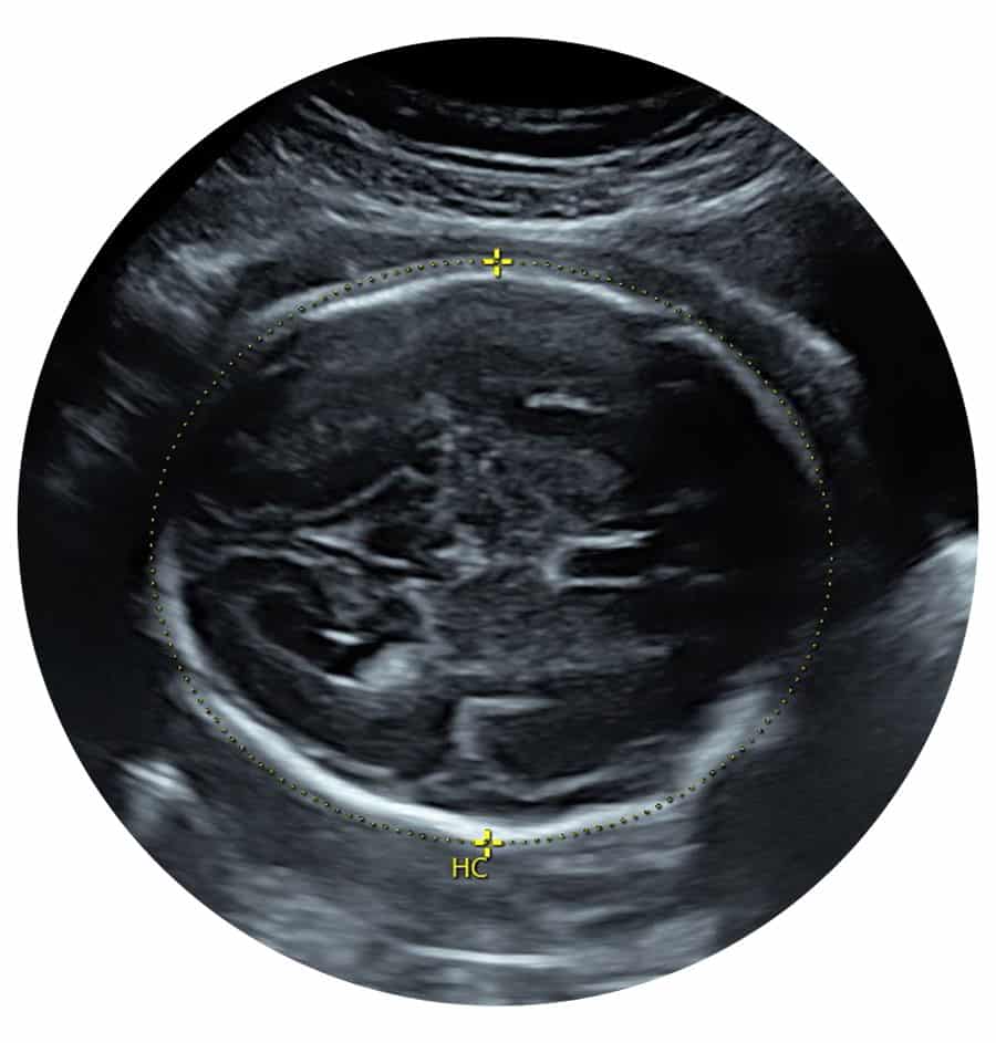 Private Growth Ultrasound Scan Chessington Surrey