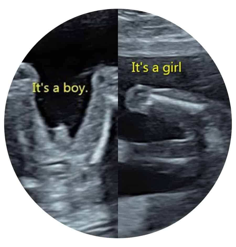 Early Gender Ultrasound Scan Rayleigh, Essex