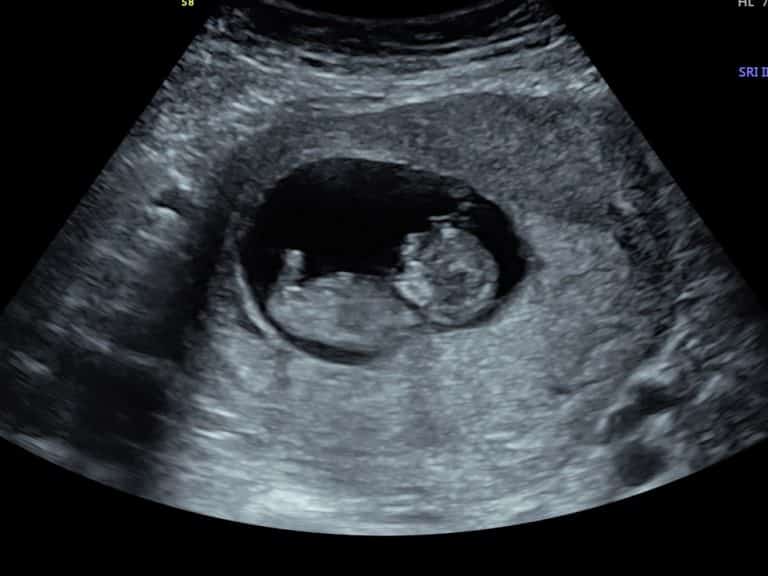 Our Early Scans Explained - Window to the Womb