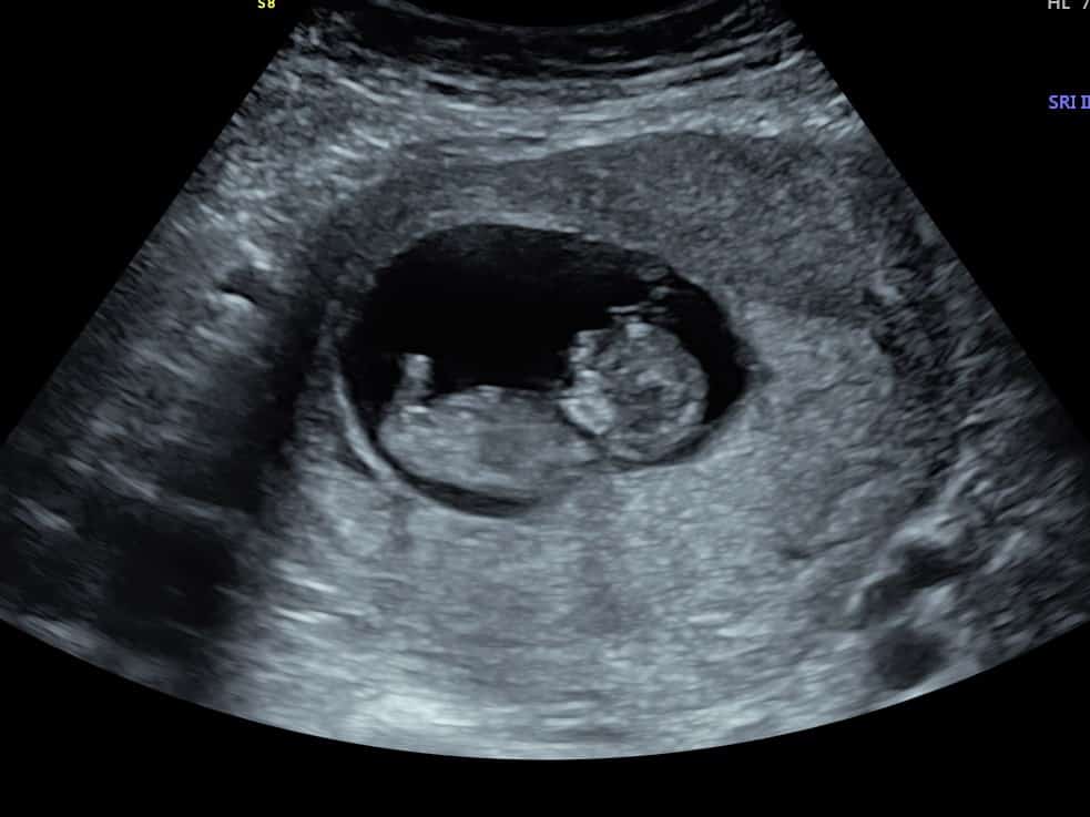 Our Early Scans Explained - to the Womb