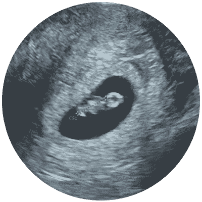 Early Scan - Viability Pregnancy Scan 