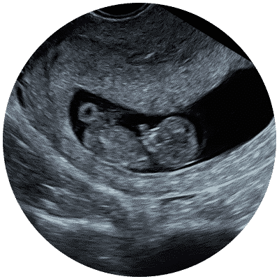 Early Scan - Specialist Pregnancy Scans