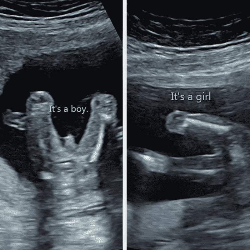 At weeks gender 13 ultrasound Gender at